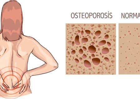 Spinal Compression Fracture, Osteoporosis