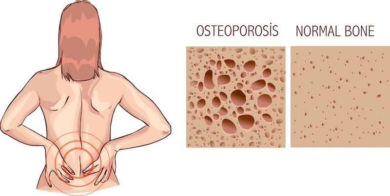 Spinal Compression Fracture, Osteoporosis