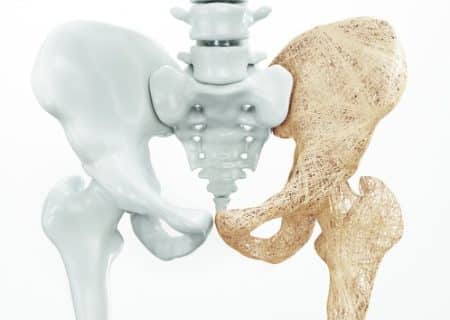 demonstration of osteoporosis