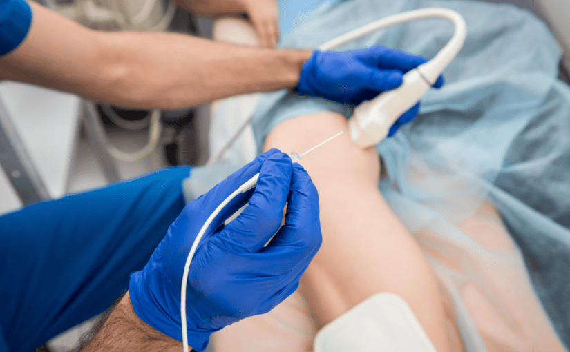 radiofrequency ablation