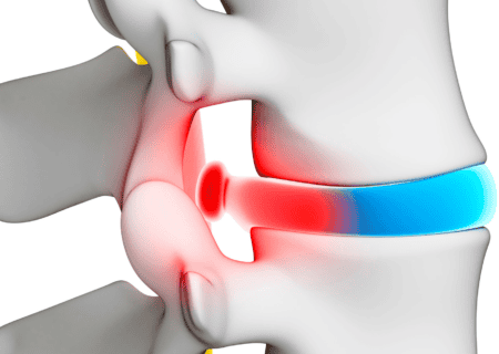 herniated disc