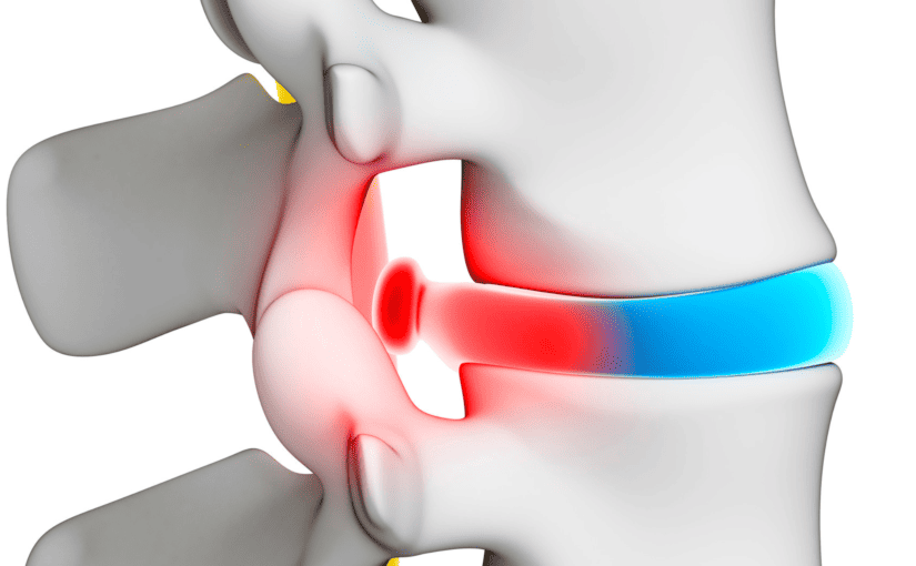 herniated disc